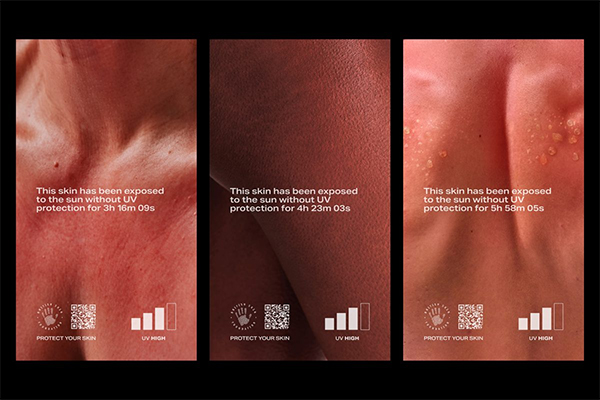 Three portrait images showing sections of skin that have been exposed to the sun without UV protection for between 3-5 hours. In each picture, skin is red and looks sore.